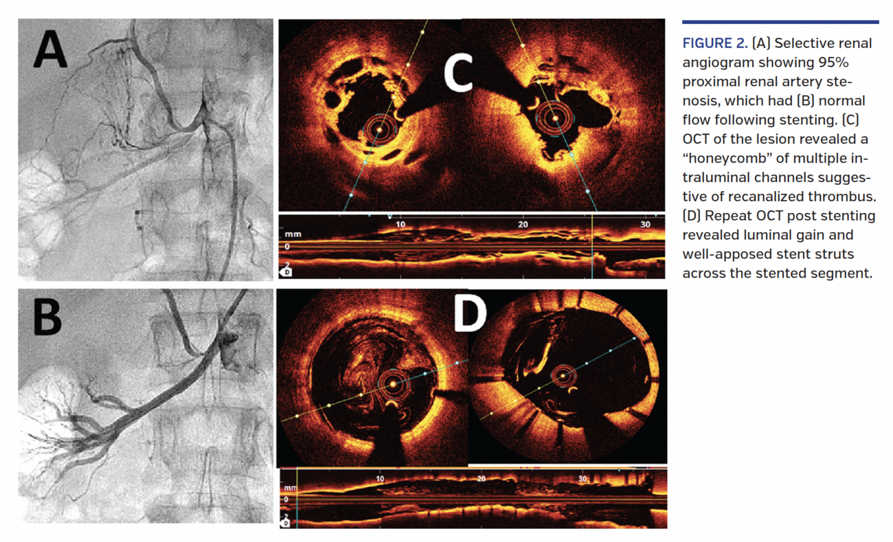 Percutaneous Renal Artery Stenting With Optical Coherence Tomography